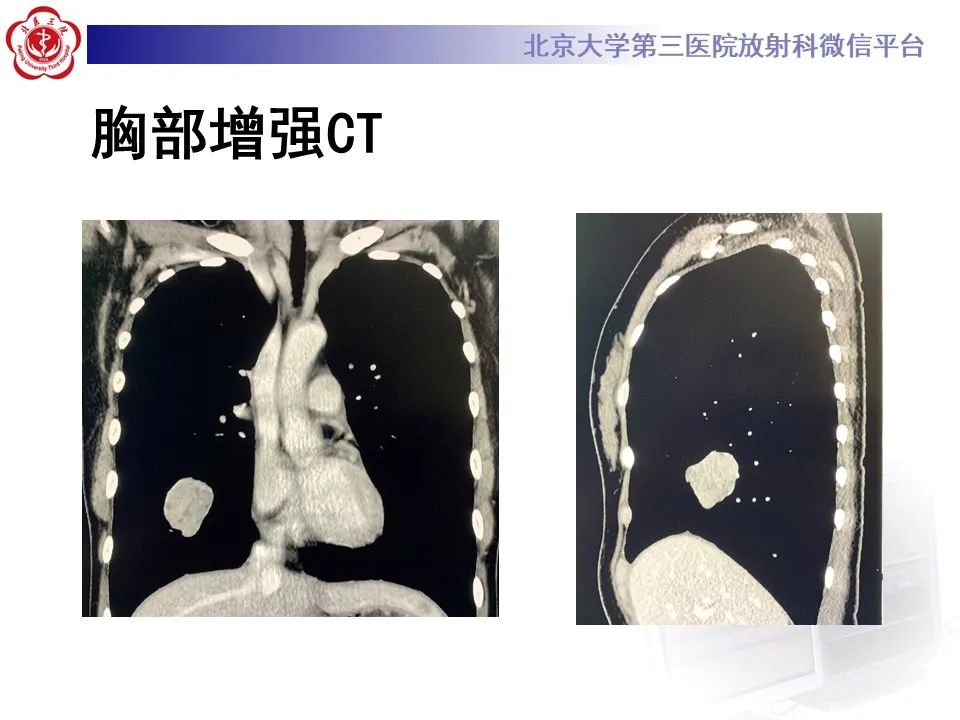 影像PPT - 【PPT】肺粘液表皮样癌-5