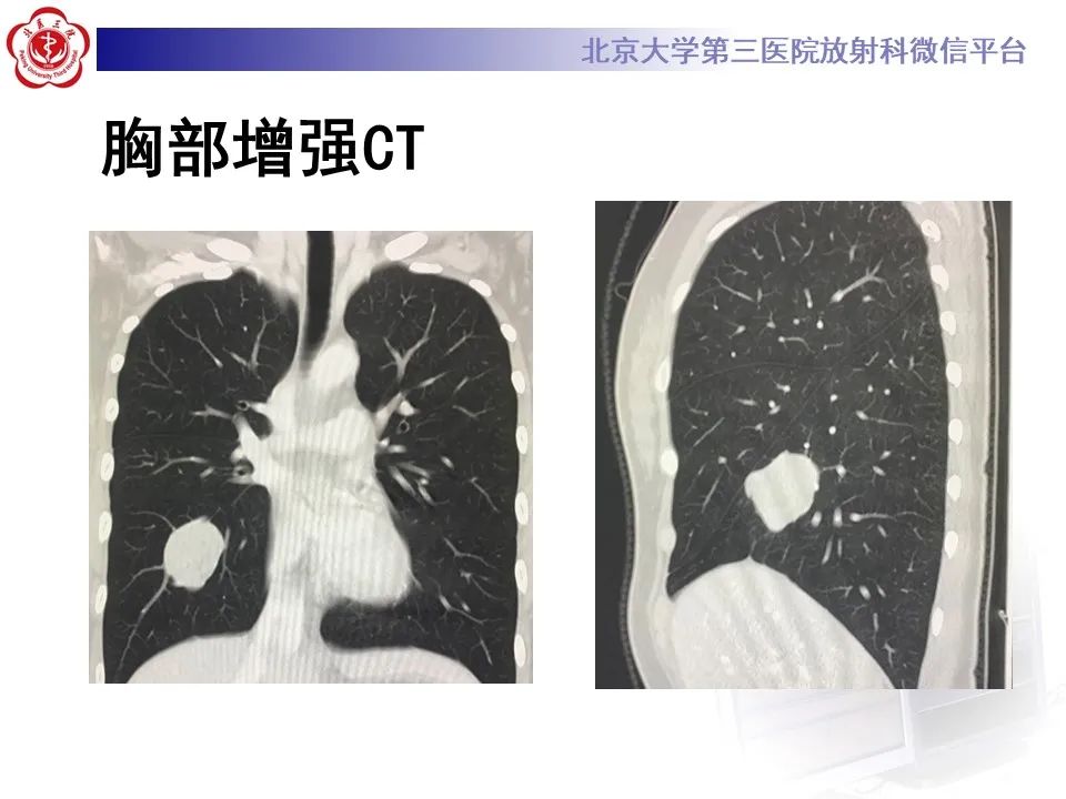 影像PPT - 【PPT】肺粘液表皮样癌-6