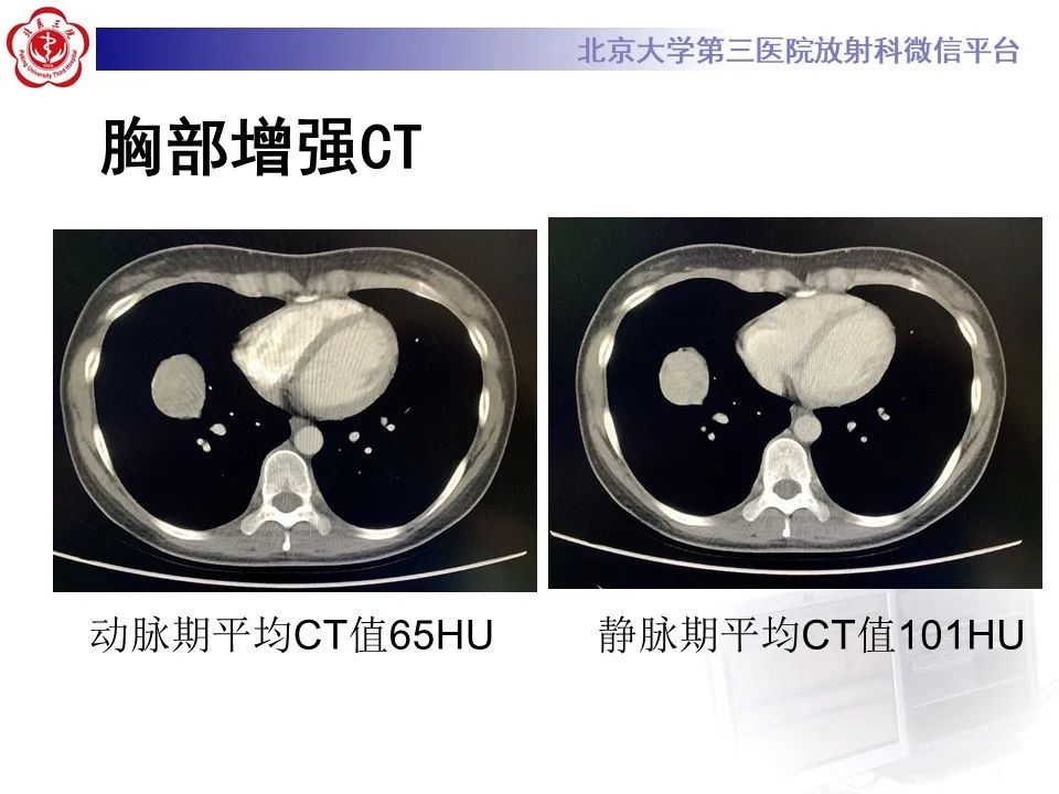 影像PPT - 【PPT】肺粘液表皮样癌-4