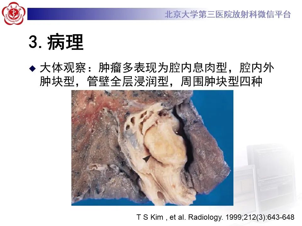 影像PPT - 【PPT】肺粘液表皮样癌-13