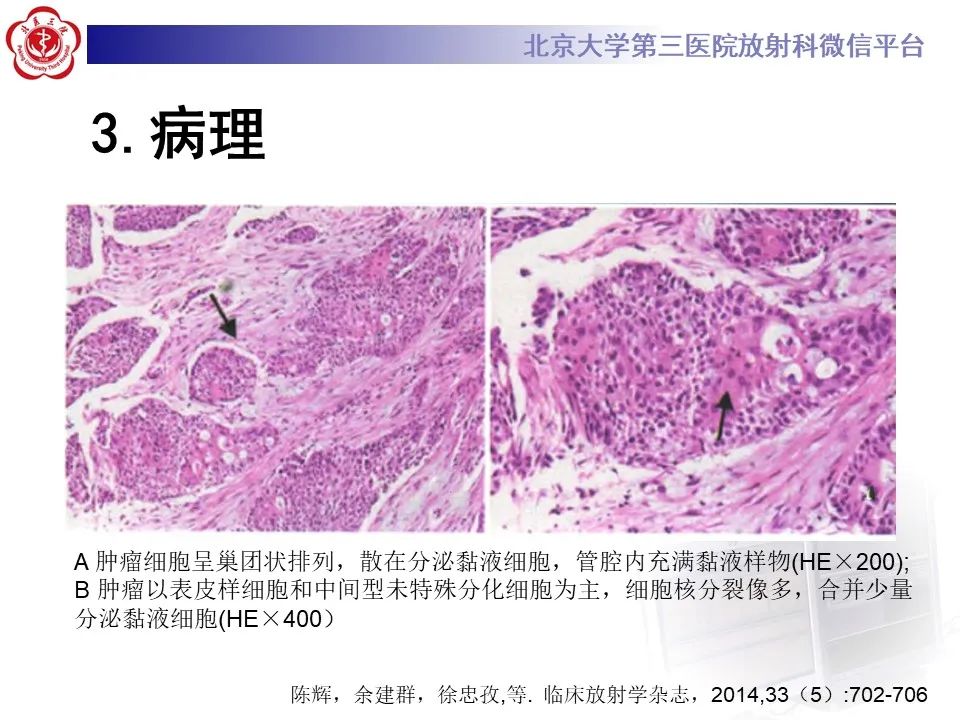 影像PPT - 【PPT】肺粘液表皮样癌-15