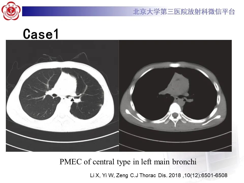 影像PPT - 【PPT】肺粘液表皮样癌-18