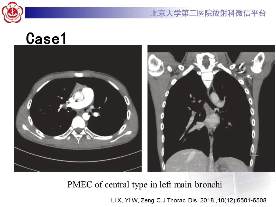 影像PPT - 【PPT】肺粘液表皮样癌-19