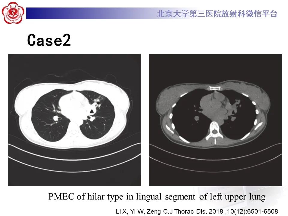 影像PPT - 【PPT】肺粘液表皮样癌-20