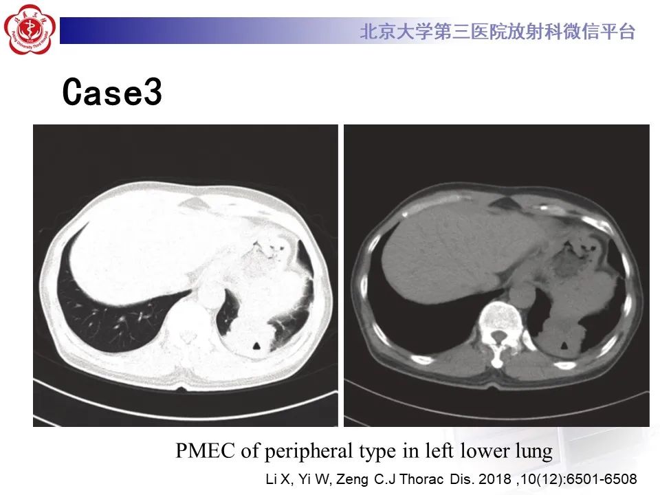 影像PPT - 【PPT】肺粘液表皮样癌-22