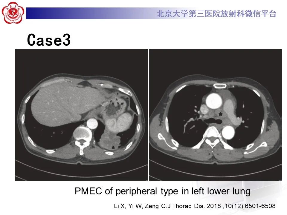 影像PPT - 【PPT】肺粘液表皮样癌-23