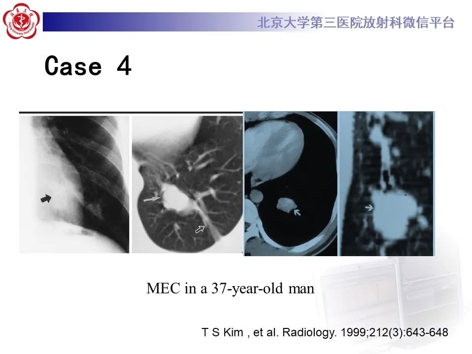影像PPT - 【PPT】肺粘液表皮样癌-24