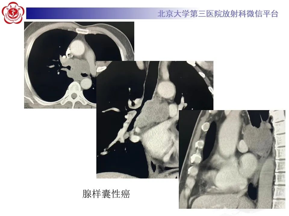 影像PPT - 【PPT】肺粘液表皮样癌-30