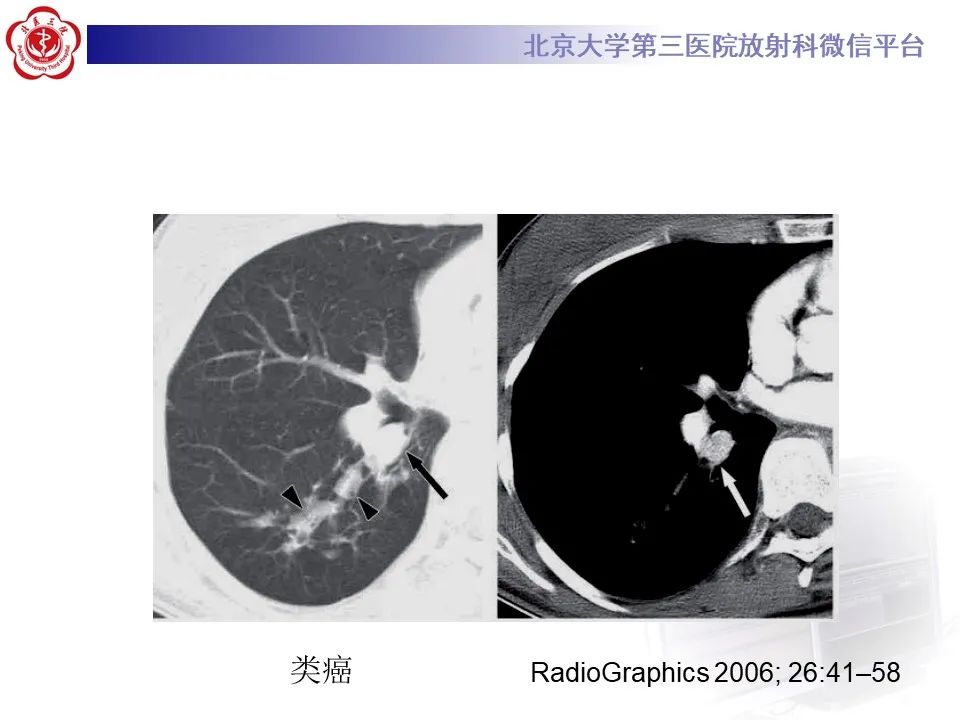 影像PPT - 【PPT】肺粘液表皮样癌-32