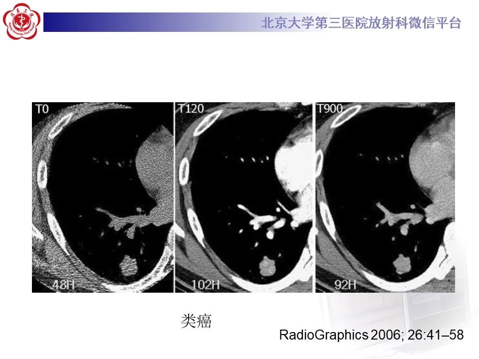 影像PPT - 【PPT】肺粘液表皮样癌-33