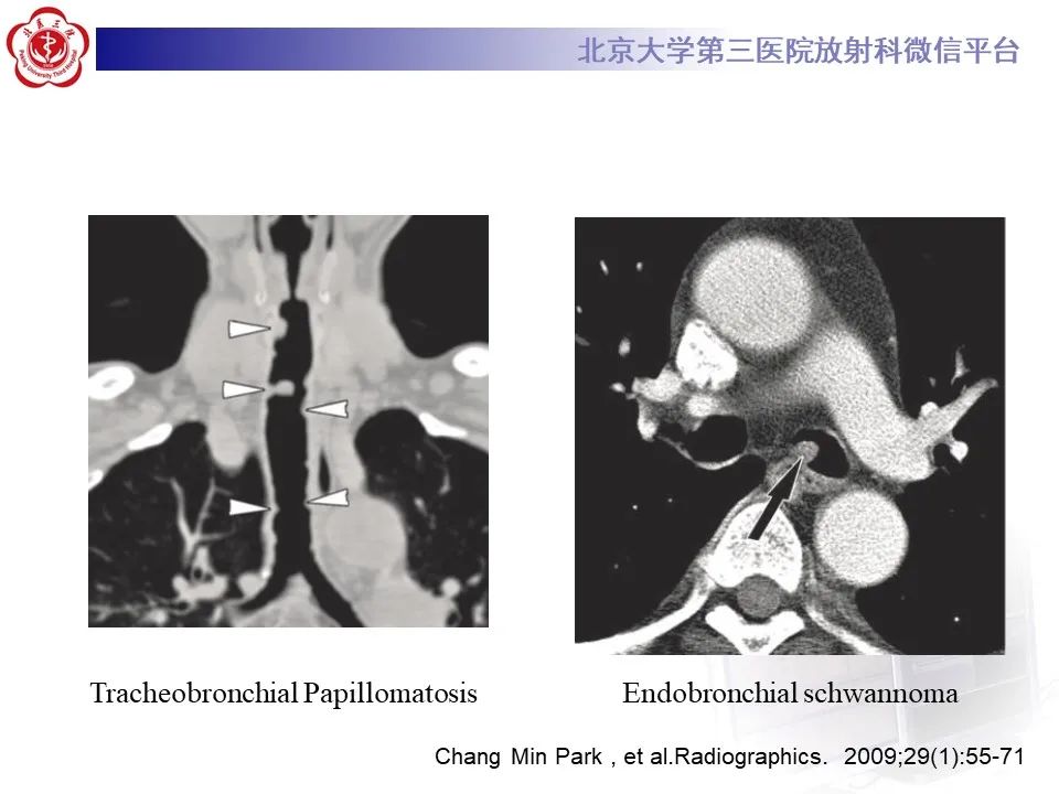 影像PPT - 【PPT】肺粘液表皮样癌-35
