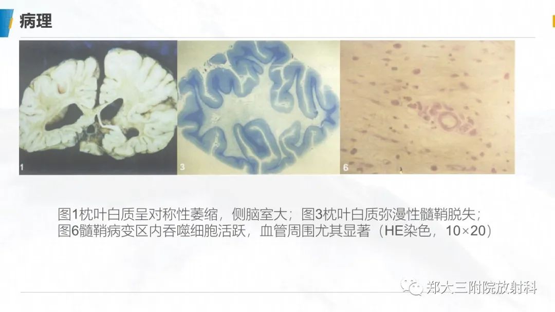 影像PPT - 【PPT】肾上腺脑白质营养不良的影像诊断-5