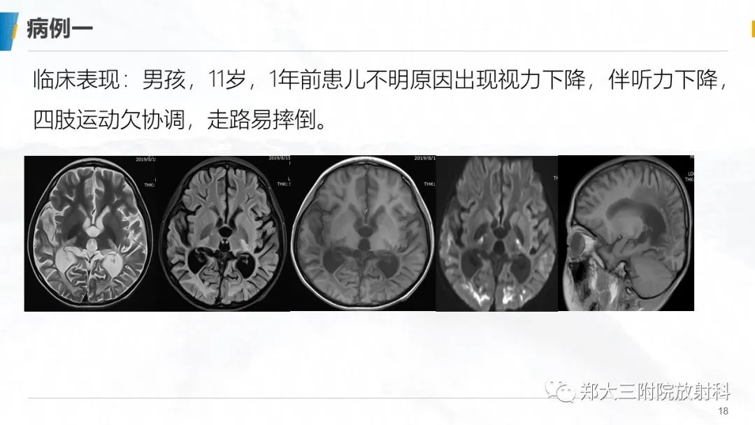 影像PPT - 【PPT】肾上腺脑白质营养不良的影像诊断-18
