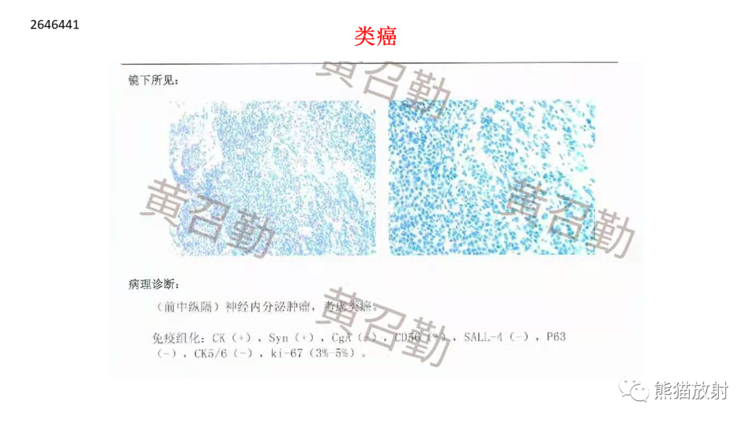 影像PPT - 【病例】胸腺神经内分泌肿瘤（类癌）2例CT影像-21