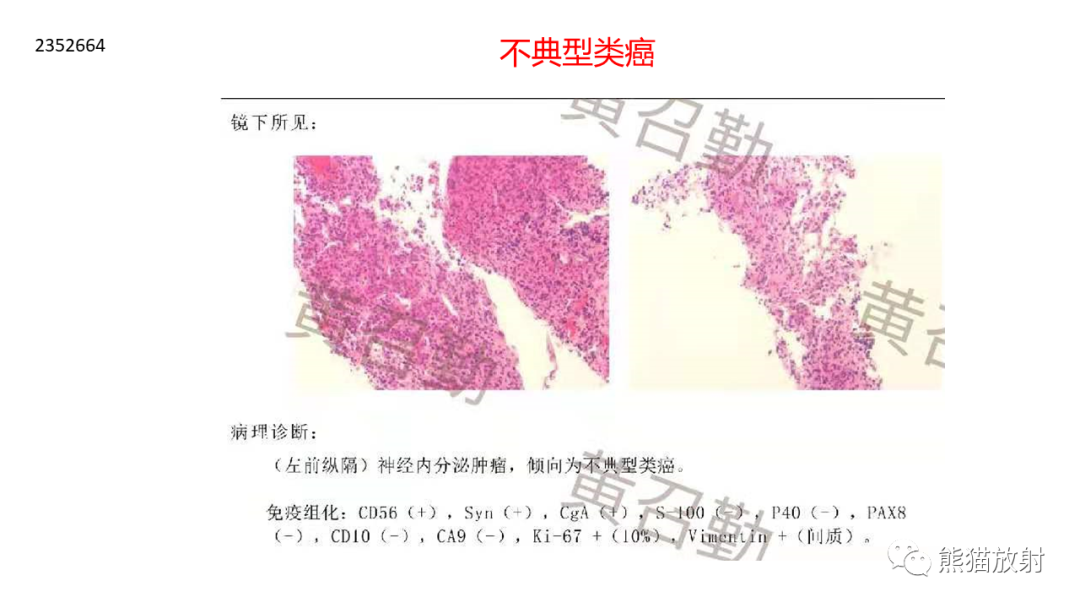 影像PPT - 【病例】胸腺神经内分泌肿瘤（类癌）2例CT影像-22