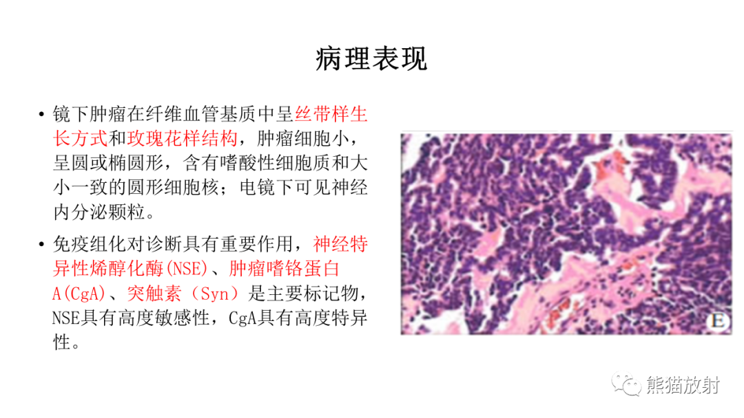 影像PPT - 【病例】胸腺神经内分泌肿瘤（类癌）2例CT影像-26