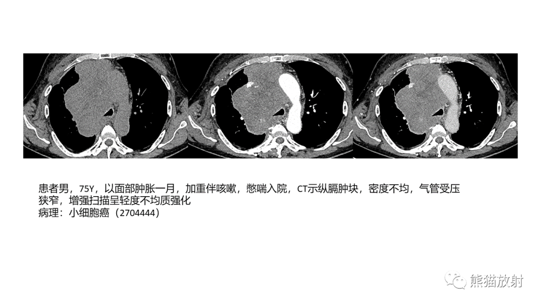 影像PPT - 【病例】胸腺神经内分泌肿瘤（类癌）2例CT影像-31