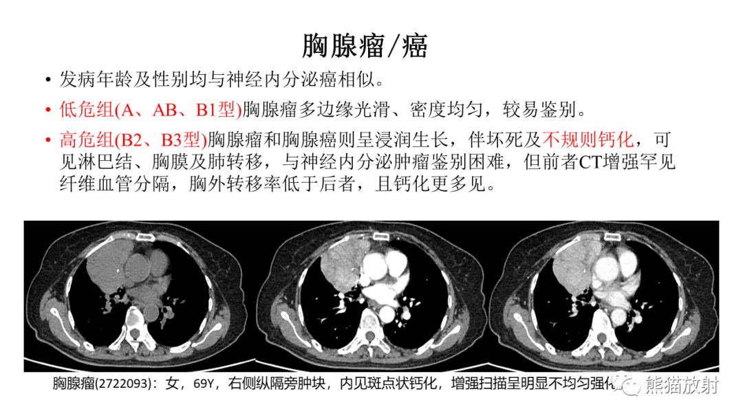 影像PPT - 【病例】胸腺神经内分泌肿瘤（类癌）2例CT影像-33