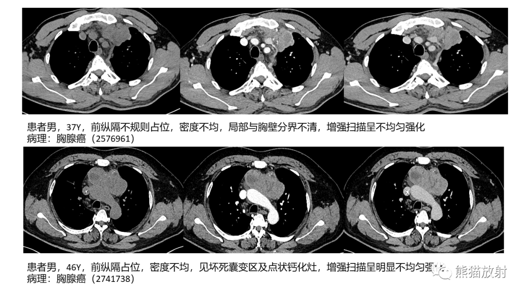 影像PPT - 【病例】胸腺神经内分泌肿瘤（类癌）2例CT影像-34