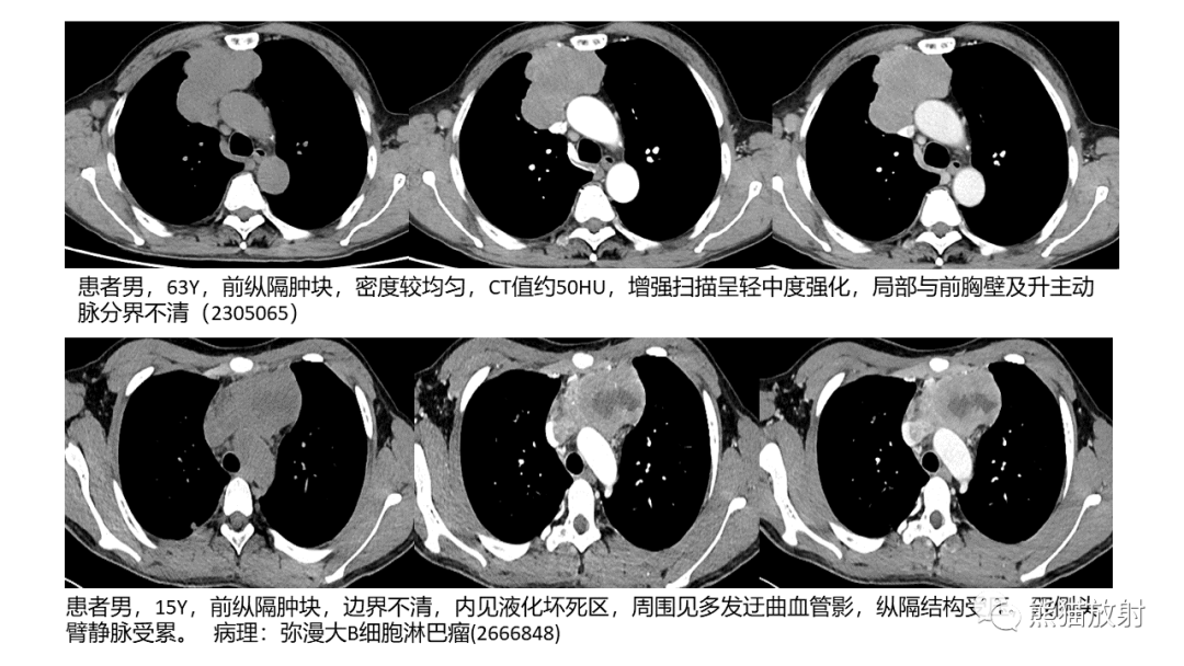 影像PPT - 【病例】胸腺神经内分泌肿瘤（类癌）2例CT影像-36