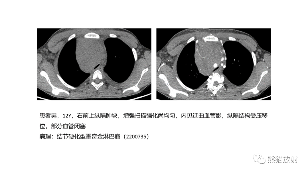 影像PPT - 【病例】胸腺神经内分泌肿瘤（类癌）2例CT影像-37