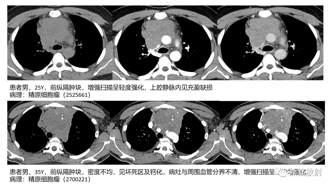 影像PPT - 【病例】胸腺神经内分泌肿瘤（类癌）2例CT影像-39