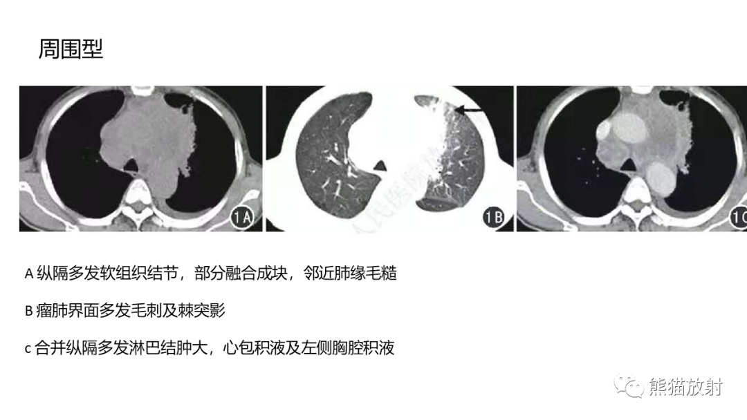 影像PPT - 【病例】胸腺神经内分泌肿瘤（类癌）2例CT影像-41