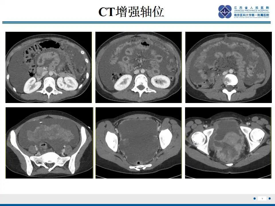 影像PPT - 【PPT】上皮样炎性肌纤维母细胞肉瘤-4