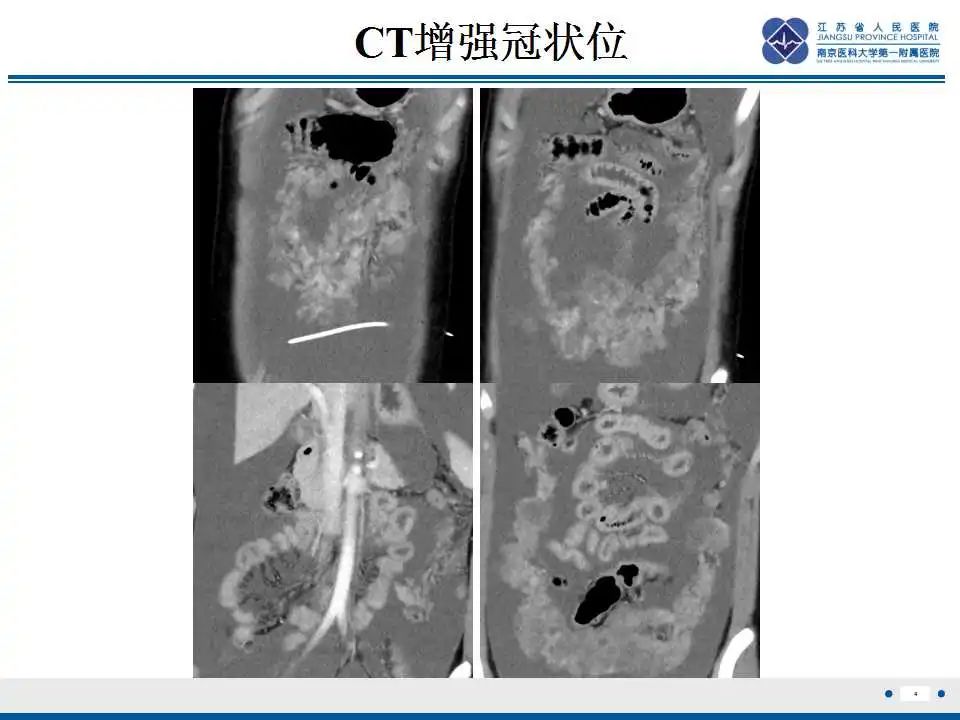 影像PPT - 【PPT】上皮样炎性肌纤维母细胞肉瘤-5