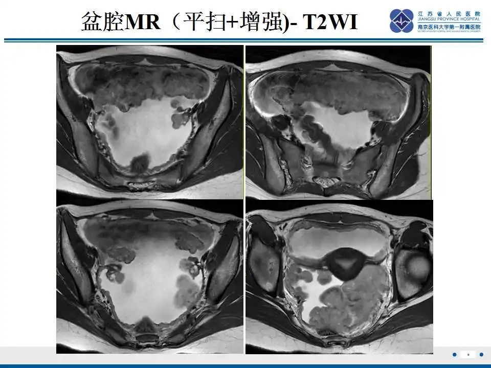 影像PPT - 【PPT】上皮样炎性肌纤维母细胞肉瘤-7