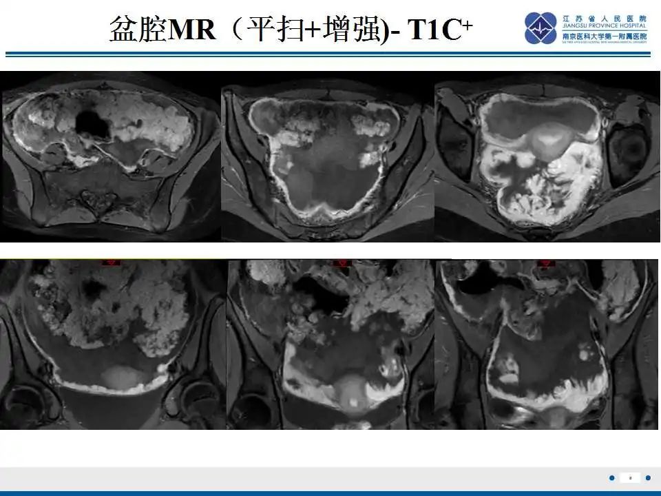 影像PPT - 【PPT】上皮样炎性肌纤维母细胞肉瘤-9