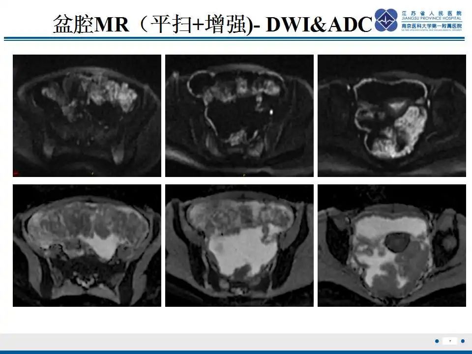 影像PPT - 【PPT】上皮样炎性肌纤维母细胞肉瘤-8
