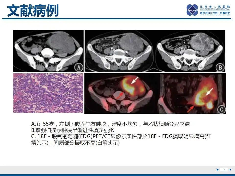影像PPT - 【PPT】上皮样炎性肌纤维母细胞肉瘤-24