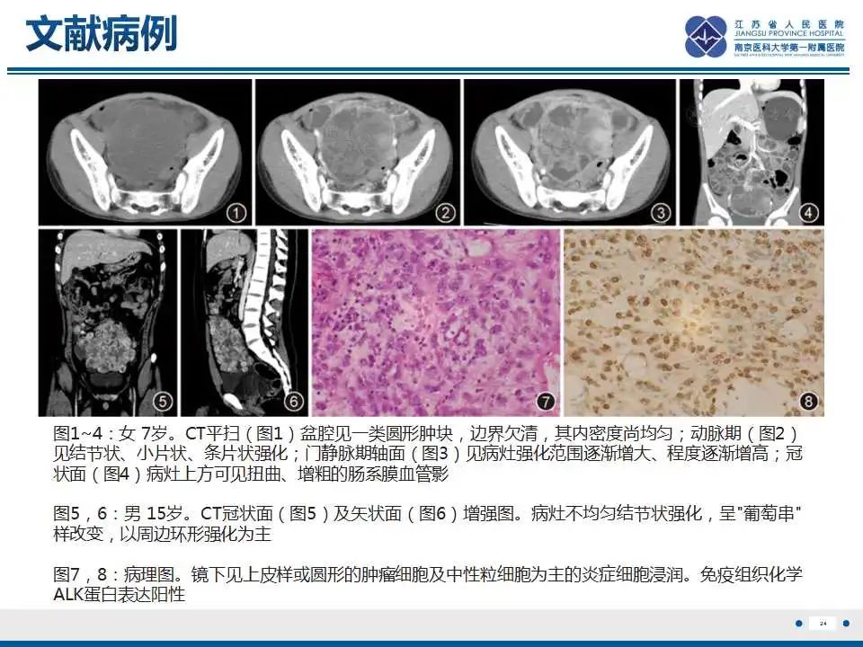影像PPT - 【PPT】上皮样炎性肌纤维母细胞肉瘤-25