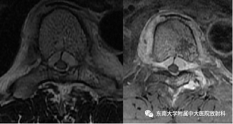 影像PPT - 【PPT】椎体孤立性肿瘤的诊断思路-4 影像PPT - 【PPT】椎体孤立性肿瘤的诊断思路-4