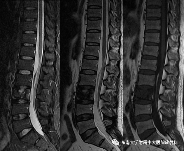影像PPT - 【PPT】椎体孤立性肿瘤的诊断思路-6 影像PPT - 【PPT】椎体孤立性肿瘤的诊断思路-6