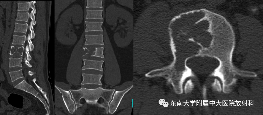影像PPT - 【PPT】椎体孤立性肿瘤的诊断思路-5 影像PPT - 【PPT】椎体孤立性肿瘤的诊断思路-5