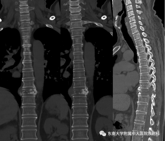影像PPT - 【PPT】椎体孤立性肿瘤的诊断思路-8 影像PPT - 【PPT】椎体孤立性肿瘤的诊断思路-8