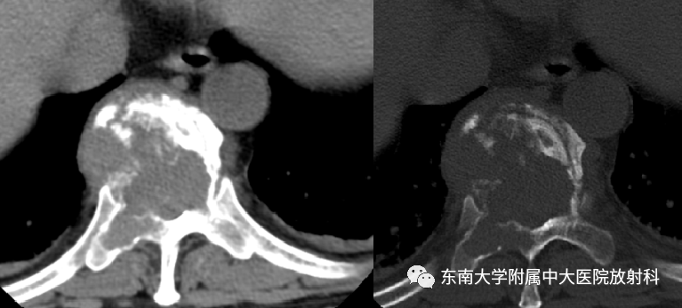 影像PPT - 【PPT】椎体孤立性肿瘤的诊断思路-9 影像PPT - 【PPT】椎体孤立性肿瘤的诊断思路-9