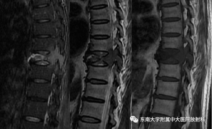 影像PPT - 【PPT】椎体孤立性肿瘤的诊断思路-10 影像PPT - 【PPT】椎体孤立性肿瘤的诊断思路-10