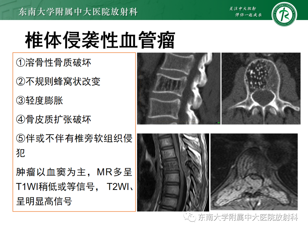 影像PPT - 【PPT】椎体孤立性肿瘤的诊断思路-16 影像PPT - 【PPT】椎体孤立性肿瘤的诊断思路-16