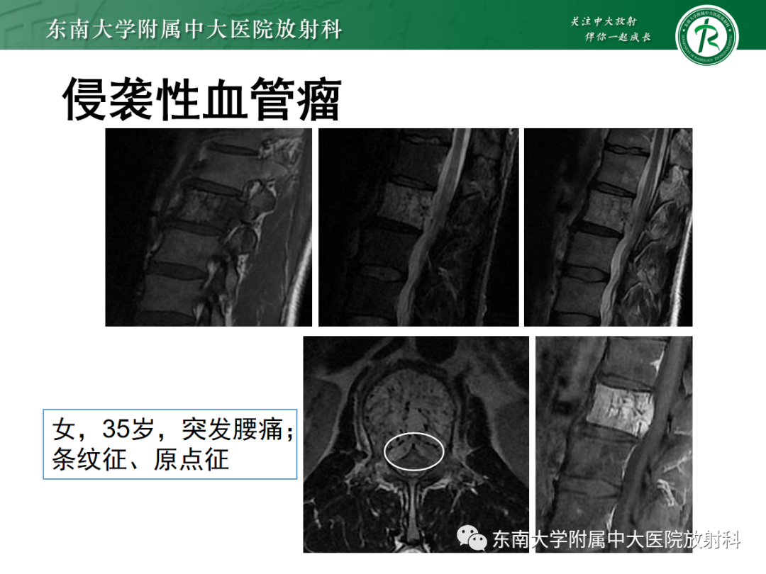 影像PPT - 【PPT】椎体孤立性肿瘤的诊断思路-17 影像PPT - 【PPT】椎体孤立性肿瘤的诊断思路-17