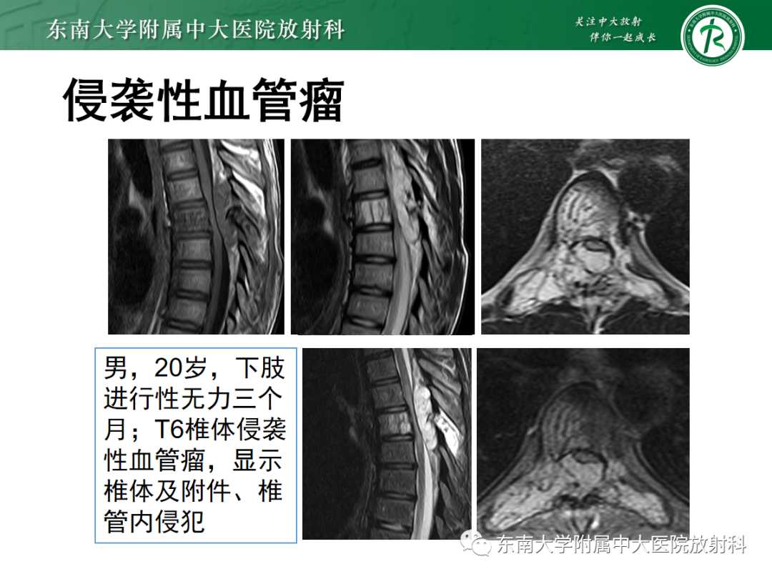 影像PPT - 【PPT】椎体孤立性肿瘤的诊断思路-18 影像PPT - 【PPT】椎体孤立性肿瘤的诊断思路-18