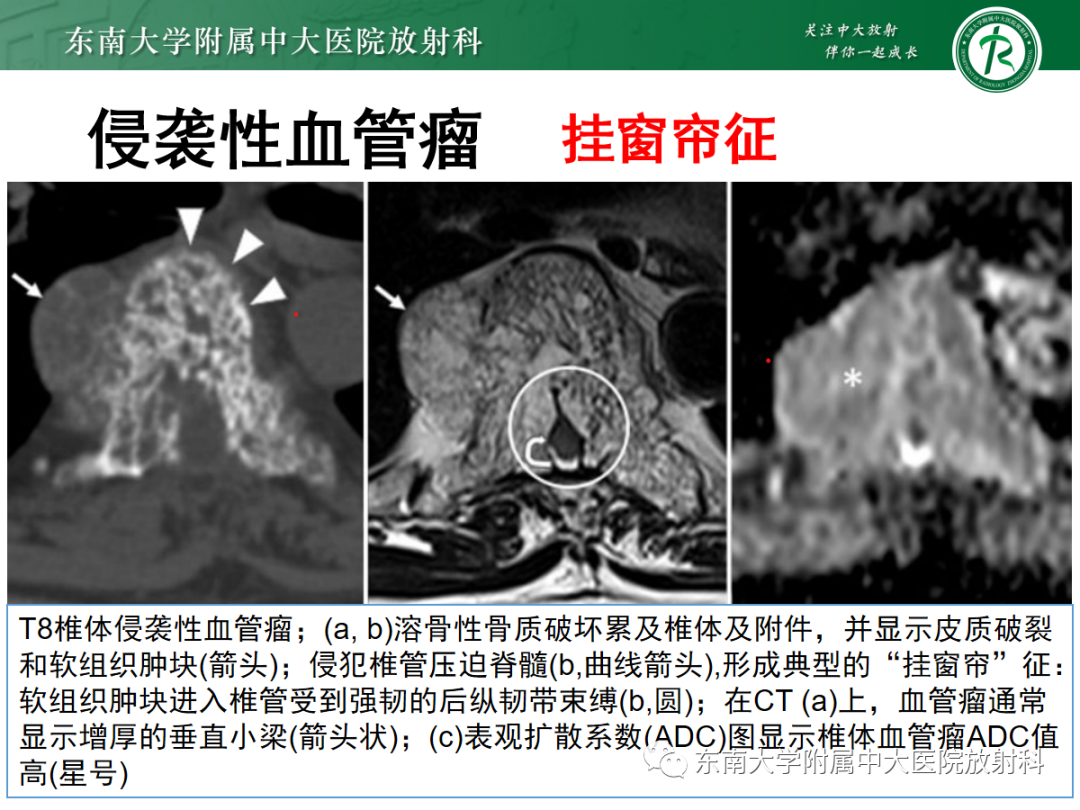 影像PPT - 【PPT】椎体孤立性肿瘤的诊断思路-19 影像PPT - 【PPT】椎体孤立性肿瘤的诊断思路-19