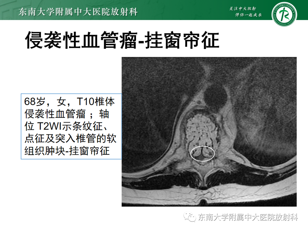 影像PPT - 【PPT】椎体孤立性肿瘤的诊断思路-20 影像PPT - 【PPT】椎体孤立性肿瘤的诊断思路-20