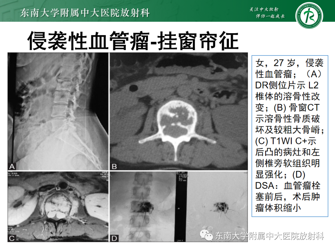 影像PPT - 【PPT】椎体孤立性肿瘤的诊断思路-21 影像PPT - 【PPT】椎体孤立性肿瘤的诊断思路-21
