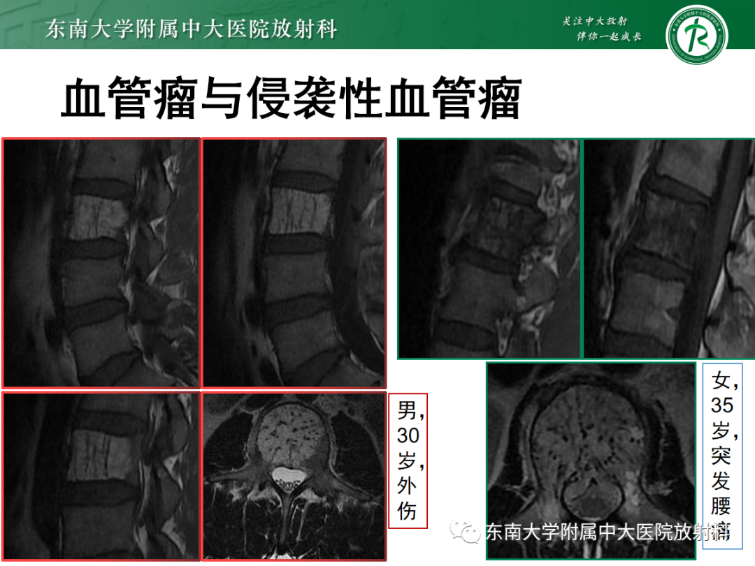 影像PPT - 【PPT】椎体孤立性肿瘤的诊断思路-22 影像PPT - 【PPT】椎体孤立性肿瘤的诊断思路-22