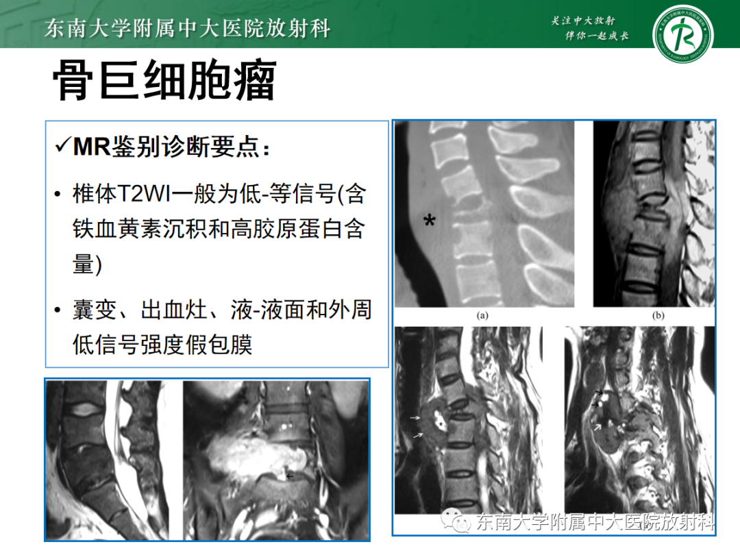 影像PPT - 【PPT】椎体孤立性肿瘤的诊断思路-24 影像PPT - 【PPT】椎体孤立性肿瘤的诊断思路-24