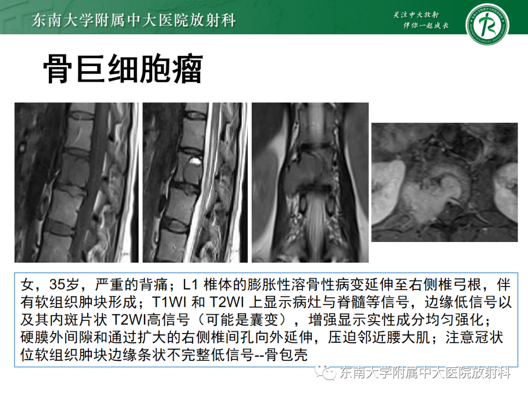 影像PPT - 【PPT】椎体孤立性肿瘤的诊断思路-25 影像PPT - 【PPT】椎体孤立性肿瘤的诊断思路-25