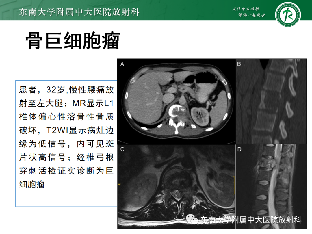 影像PPT - 【PPT】椎体孤立性肿瘤的诊断思路-26 影像PPT - 【PPT】椎体孤立性肿瘤的诊断思路-26